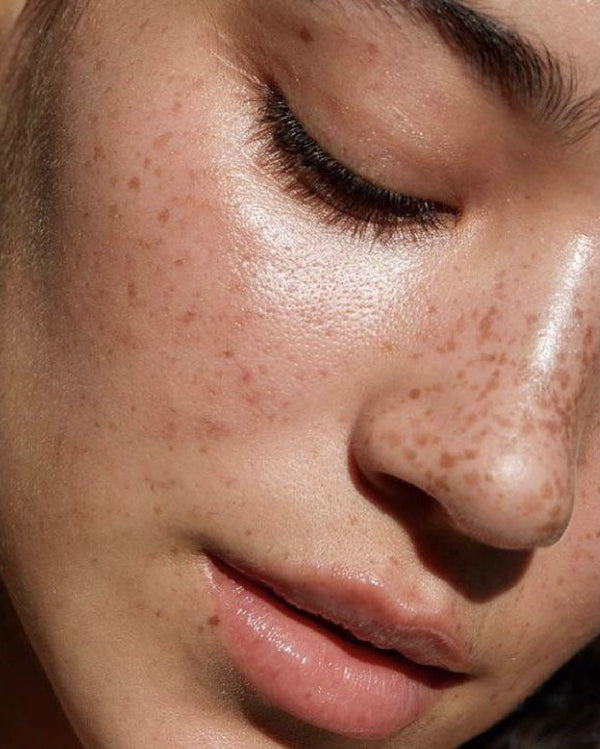 Dark Spots & Pigmentation